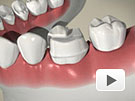 ID Dental - Crown Cusp Fracture 3/4 Crown