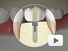 ID Dental - Implant Screw Fixed Crown