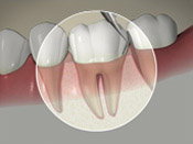 ID Dental - About Periodontal Disease